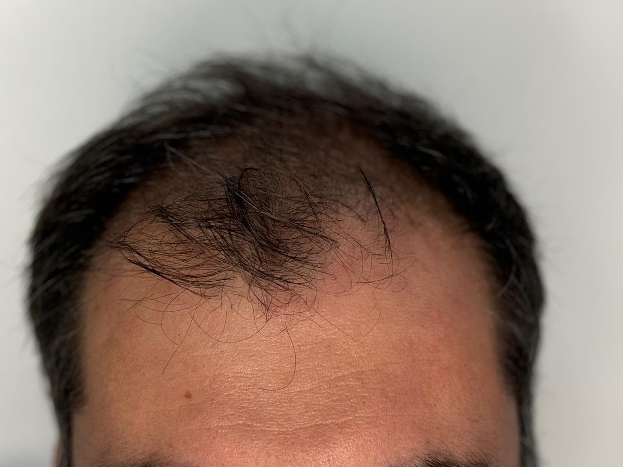 Caso 3 antes del implante