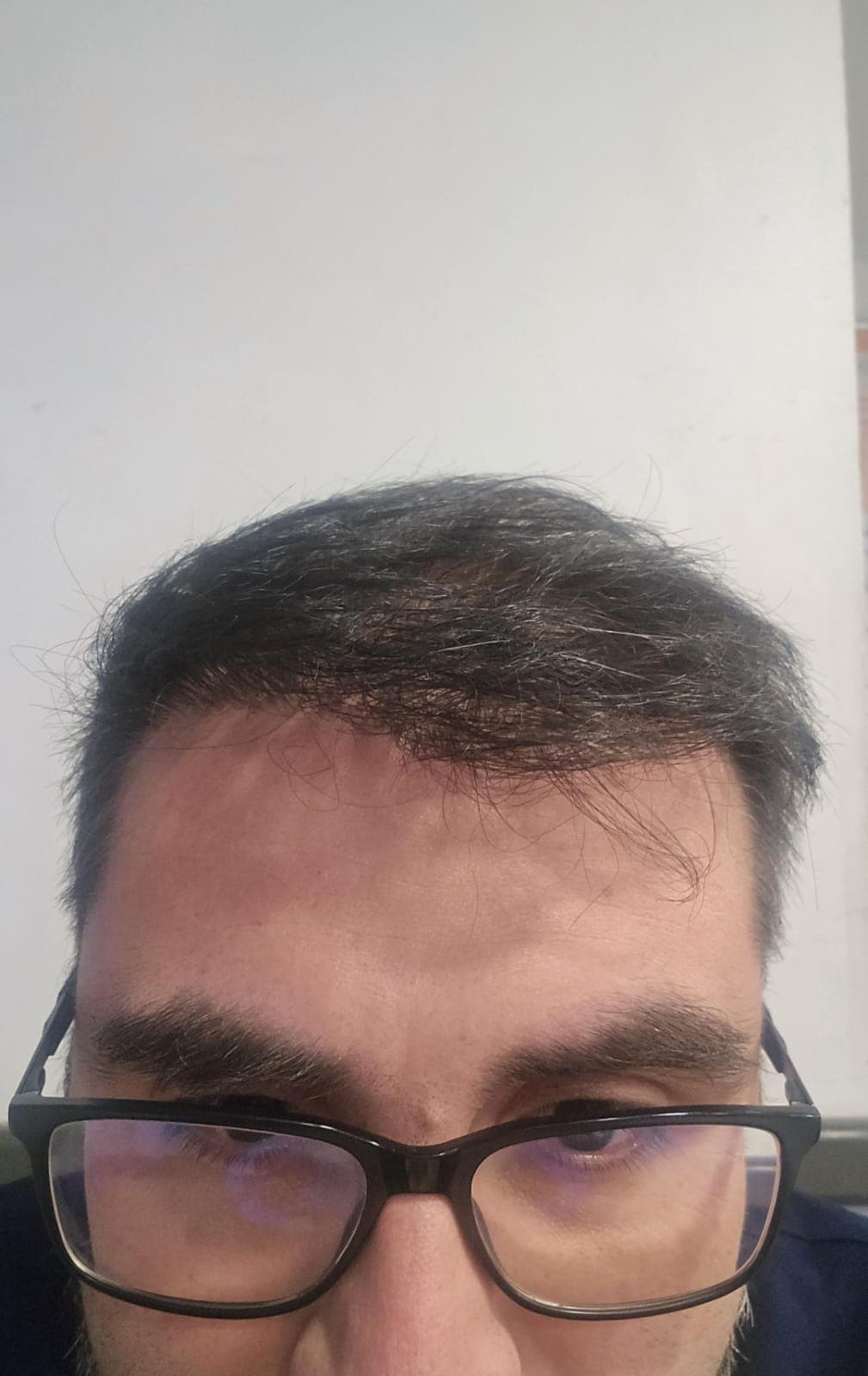 Caso 3 después del implante