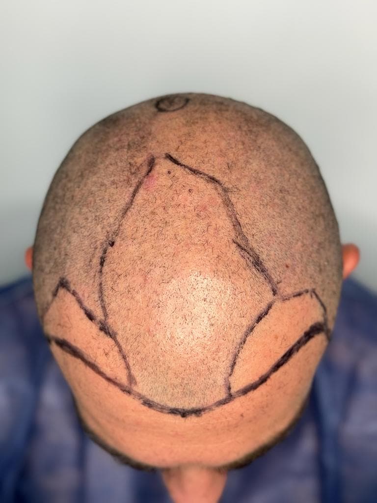 Caso 2 antes del implante