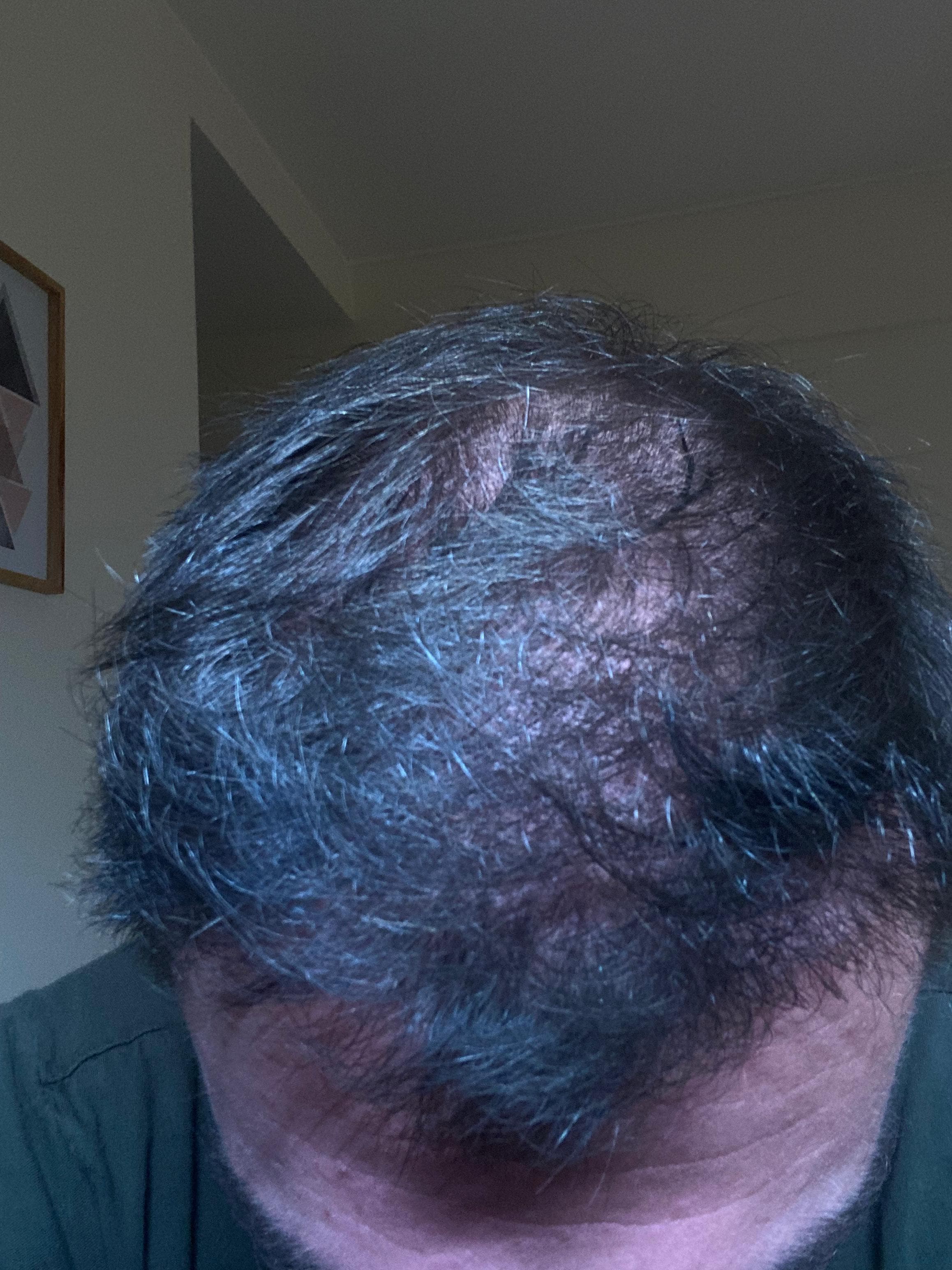 Caso 2 después del implante