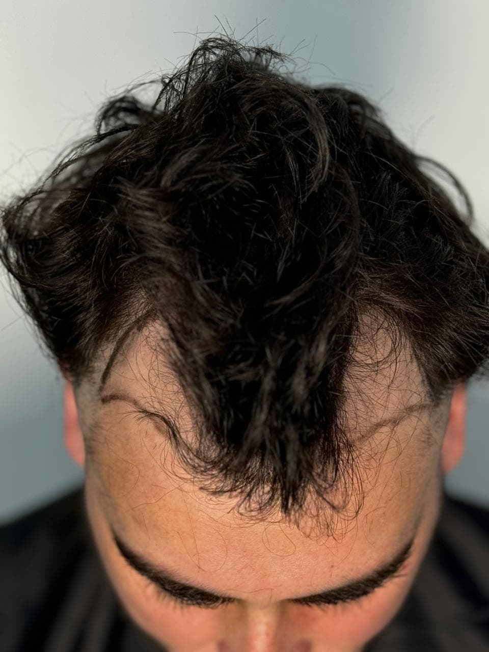 Caso 1 antes del implante