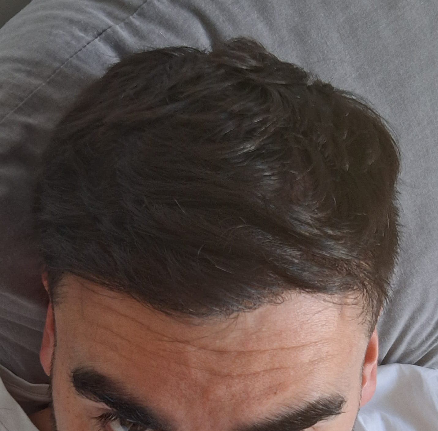 Caso 1 después del implante