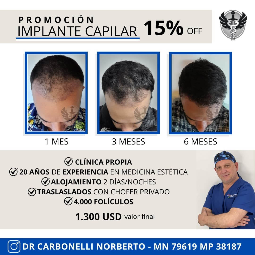 Promoción implante capilar - 15% OFF