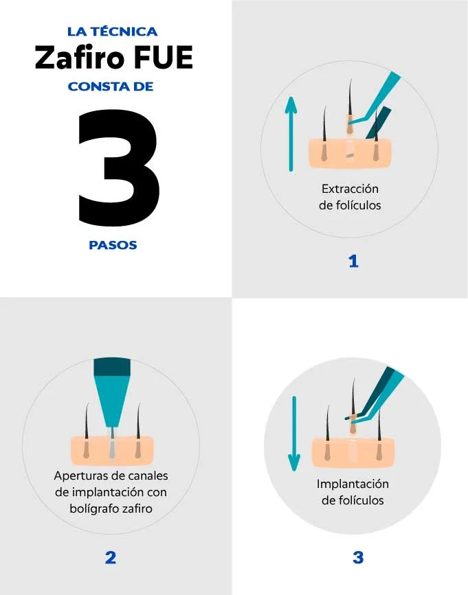 Proceso de implante capilar en tres pasos